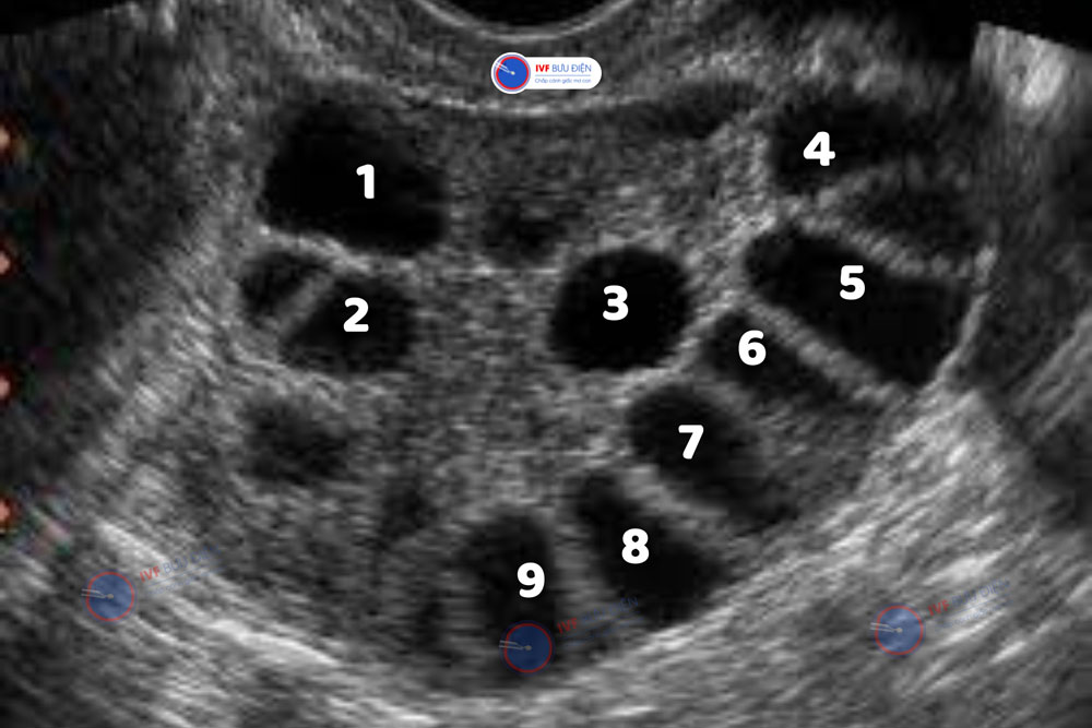 Hinh ảnh siêu âm buồng trứng đa nang