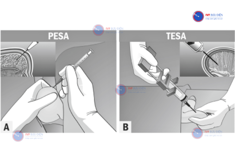 pesa là gì