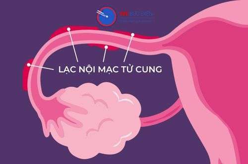 lạc nội mạc tử cung 