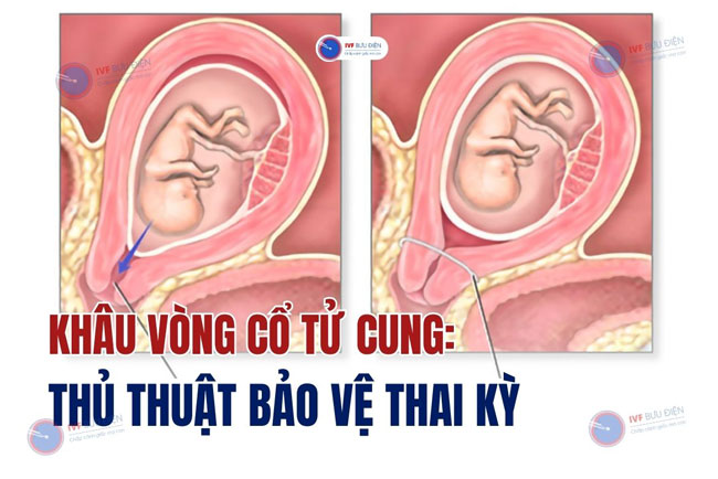 Khâu vòng cổ tử cung: Thủ thuật quan trọng giúp bảo vệ thai kỳ