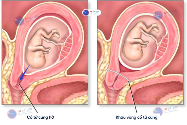 Khâu vòng cổ tử cung là gì