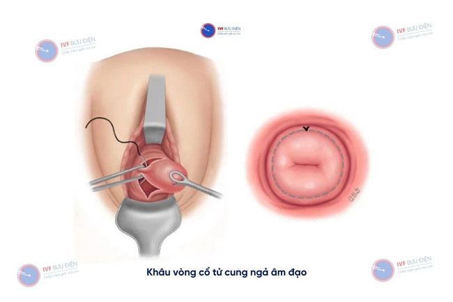 Khâu vòng tử cung ngả âm đạo