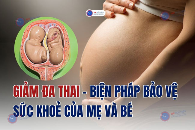 Giảm đa thai – Biện pháp bảo vệ sức khoẻ của mẹ và bé
