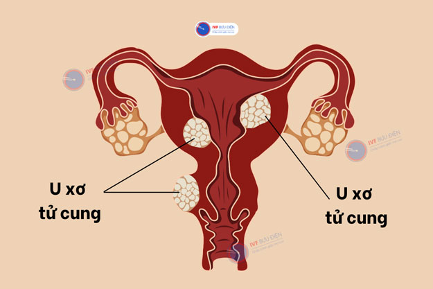 U xơ tử cung 