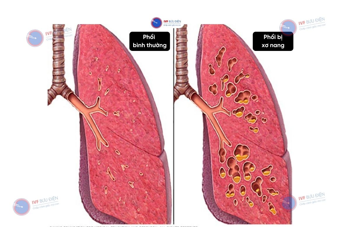  Phổi của người bình thường và phổi của người bị xơ nang 
