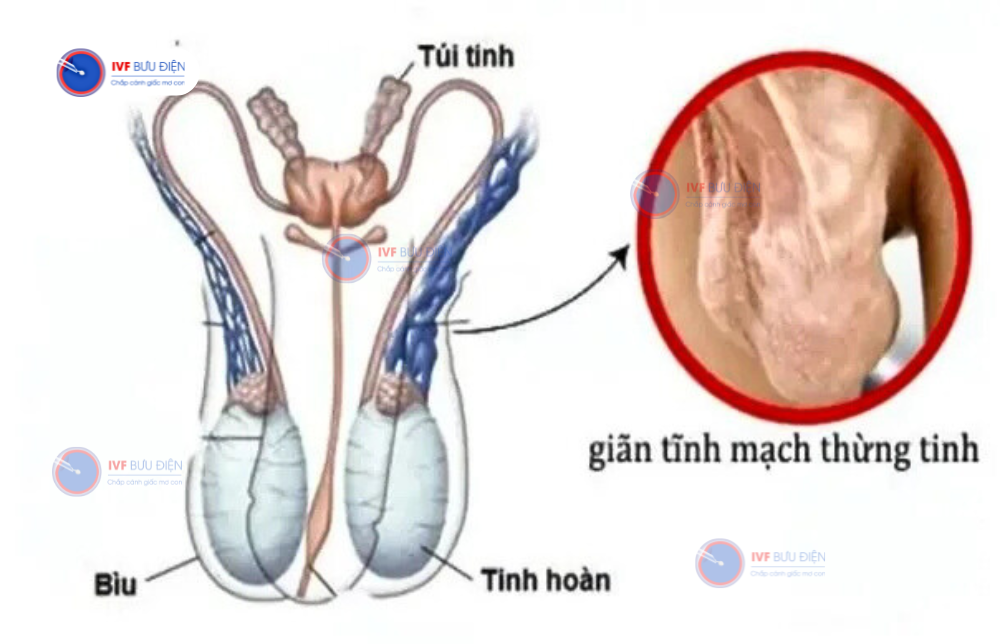 giãn tĩnh mạch thừng tinh