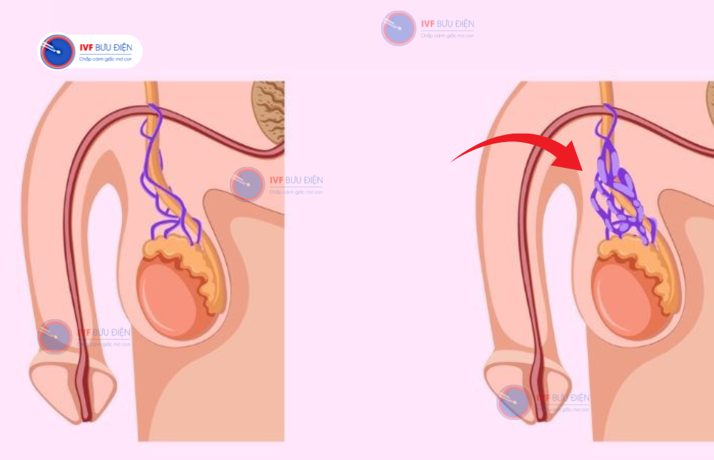 chi phí mổ giãn tĩnh mạch thừng tinh