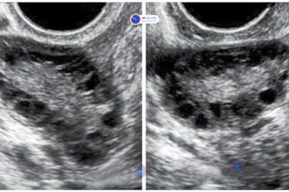 Thời điểm siêu âm buồng trứng đa nang tốt nhất