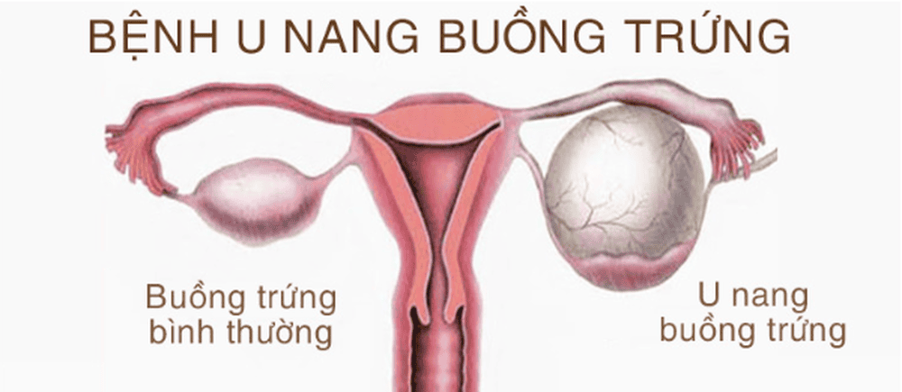 Dấu hiệu nhận biết U nang buồng trứng