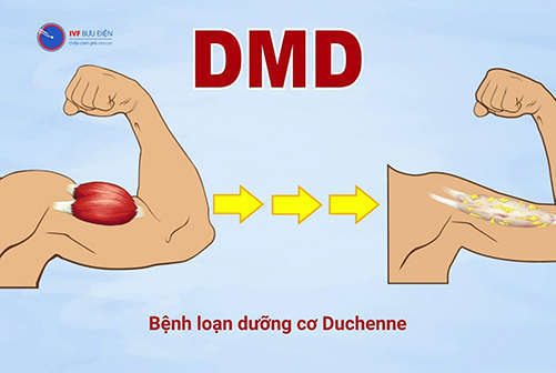 Hình ảnh bệnh dưỡng cơ Duchenne 