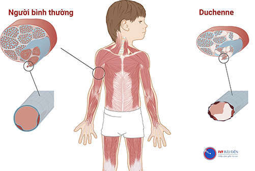 Sàng lọc di truyền có thể giúp chẩn đoán và điều trị sớm bệnh 