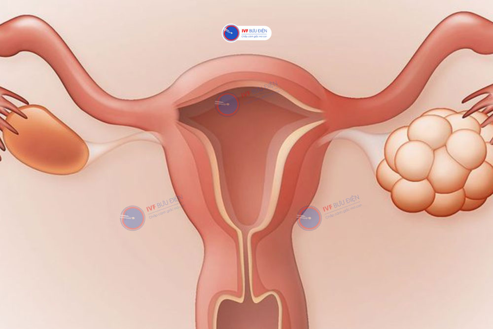 Hội chứng quá kích buồng trứng