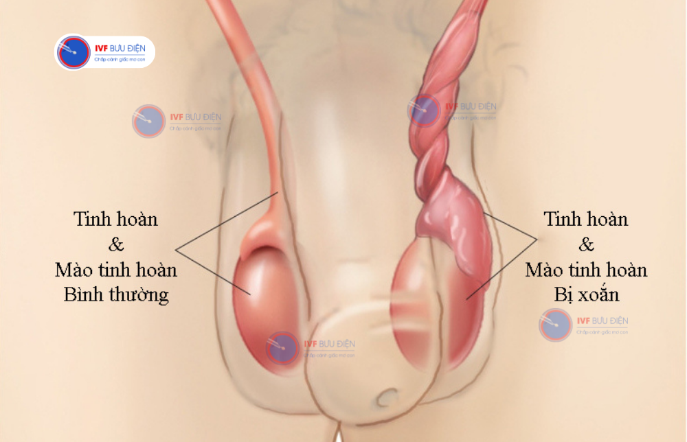 tinh hoàn ẩn gây ra xoắn tinh hoàn