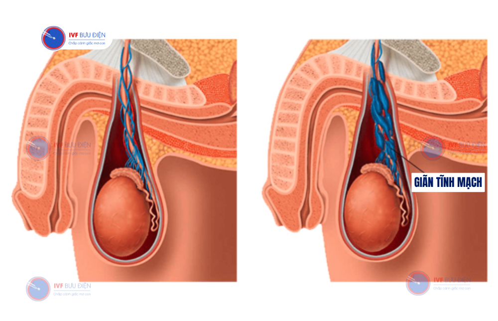 giãn tĩnh mạch thừng tinh