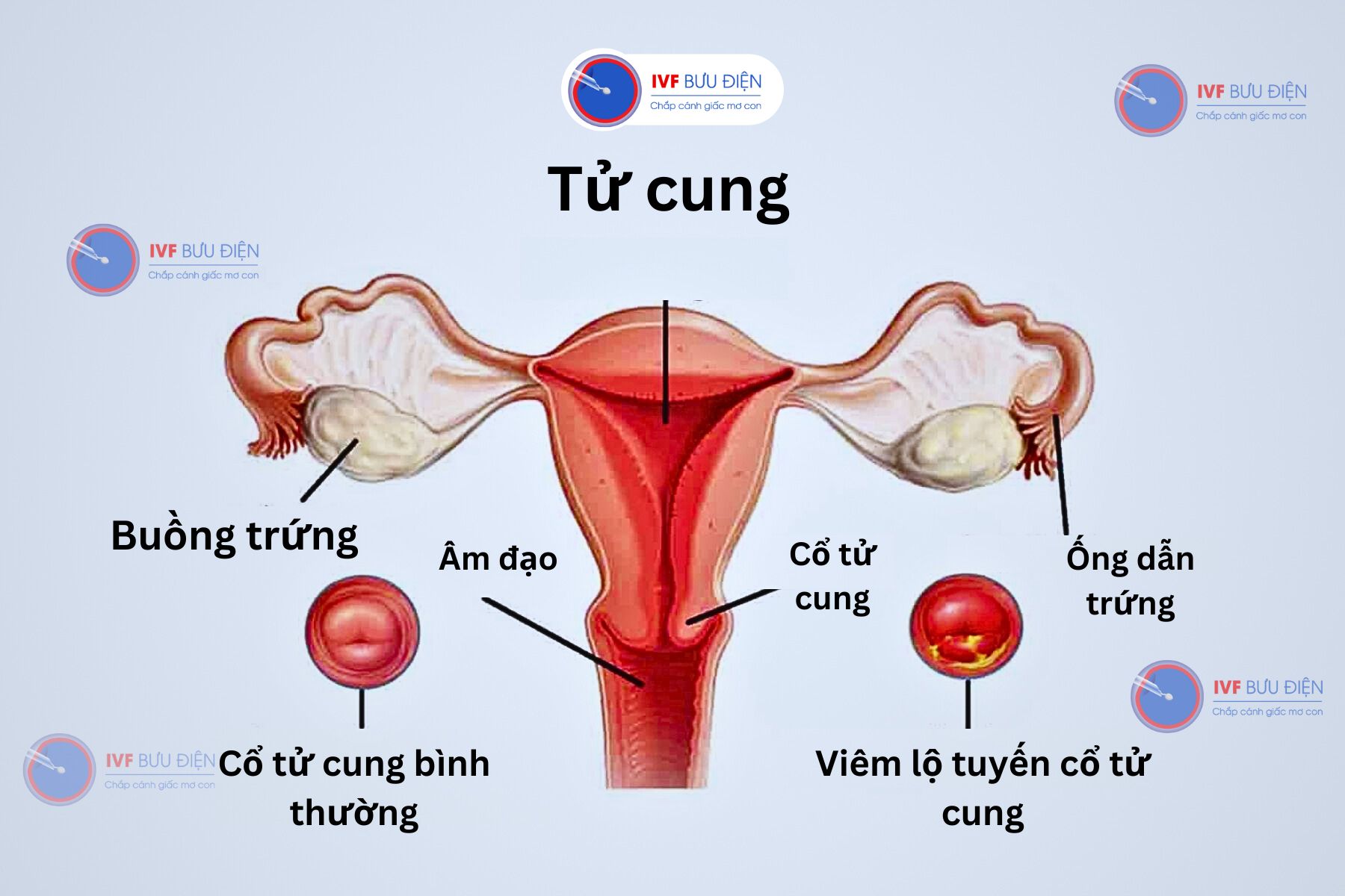 Viêm lộ tuyến cổ tử cung là gì