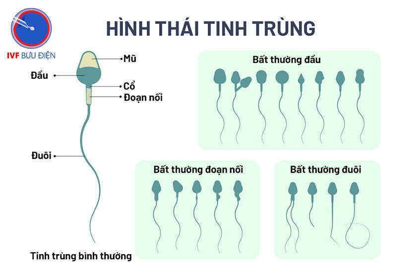 Dị dạng tinh trùng: nguyên nhân và điều trị