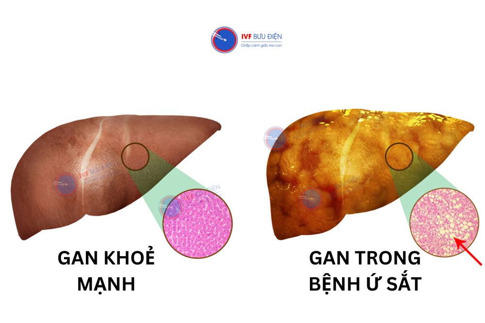 Thừa sắt trong máu gây ra một số bệnh về gan