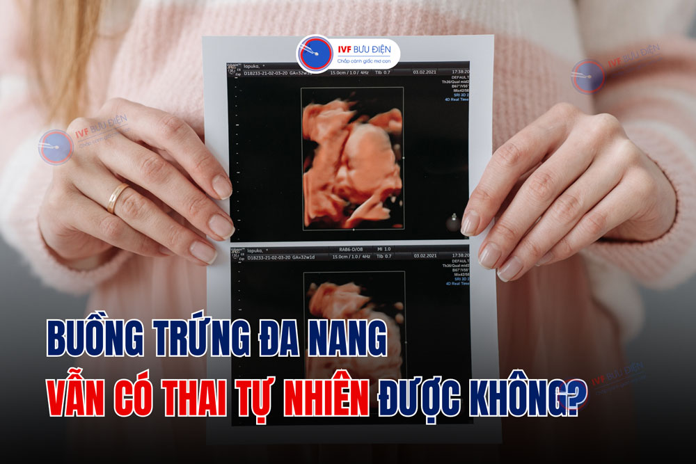 Buồng trứng đa nang vẫn có thai tự nhiên được không?