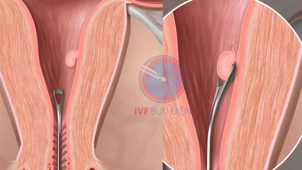 Polyp buồng tử cung: nguyên nhân, chẩn đoán và điều trị