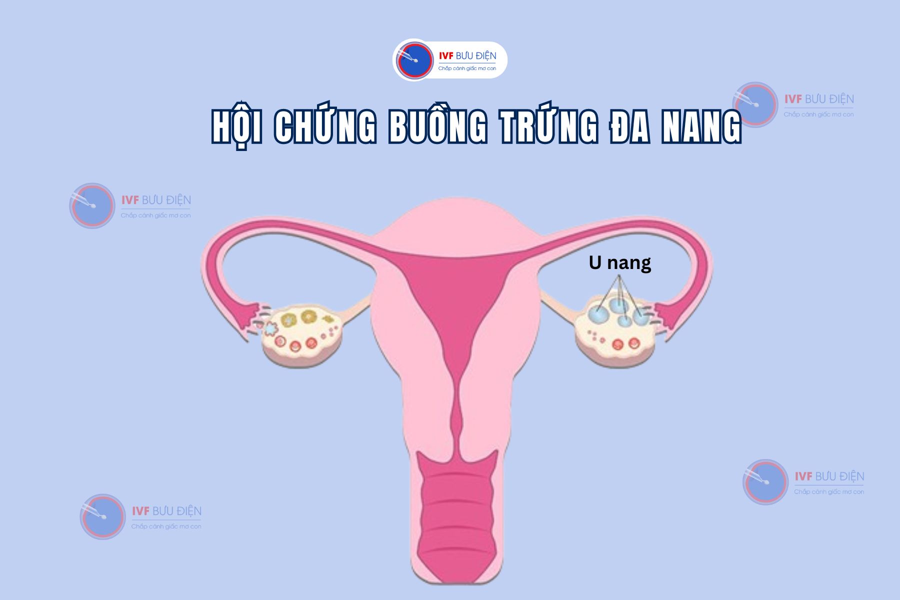 Buồng trứng đa nang là gì