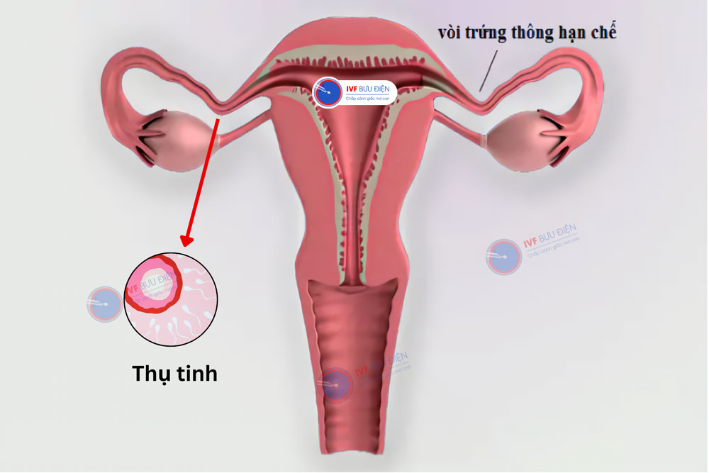 Gia đình có thai tự nhiên sau IUI thất bại