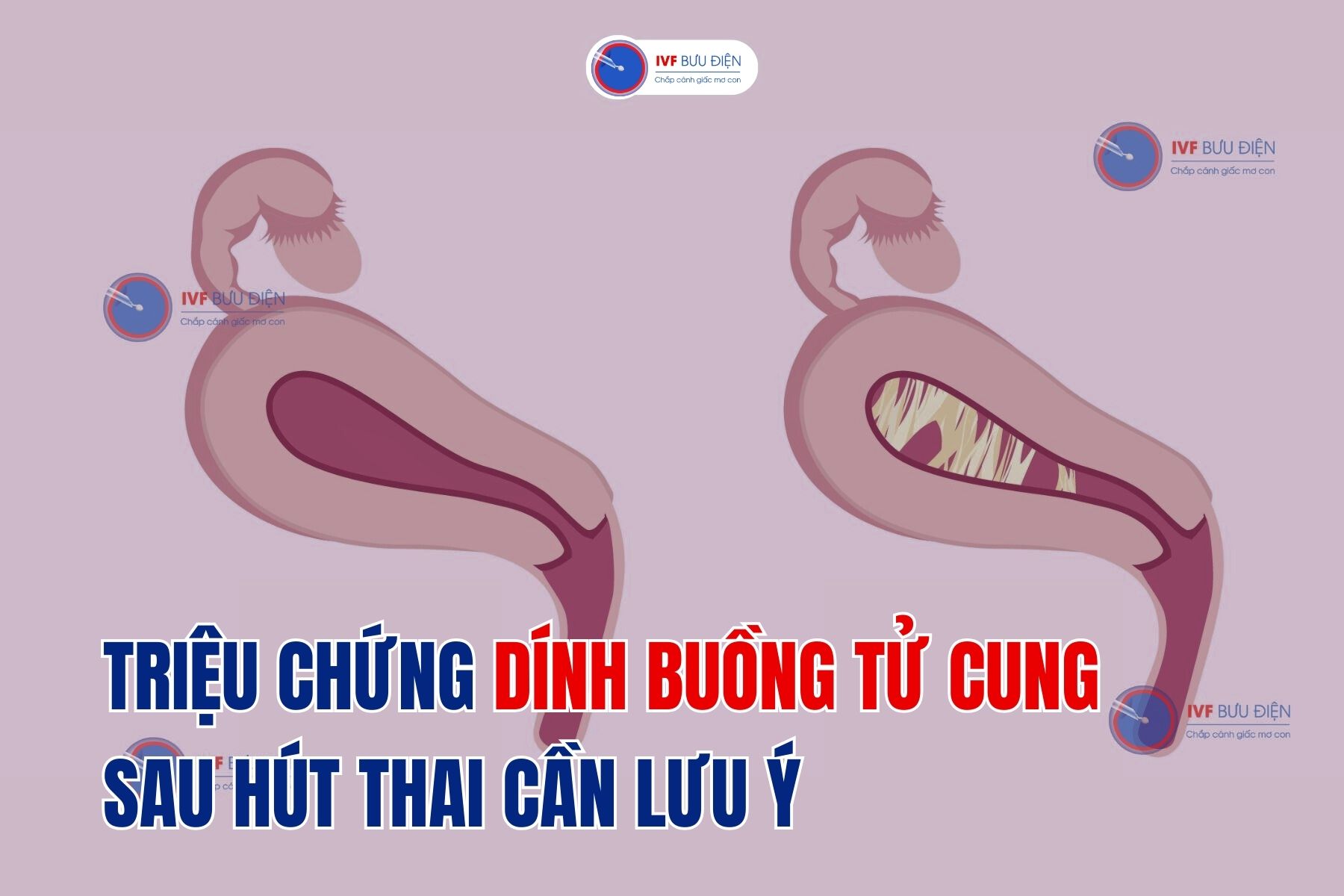 Triệu chứng dính buồng tử cung sau hút thai cần lưu ý