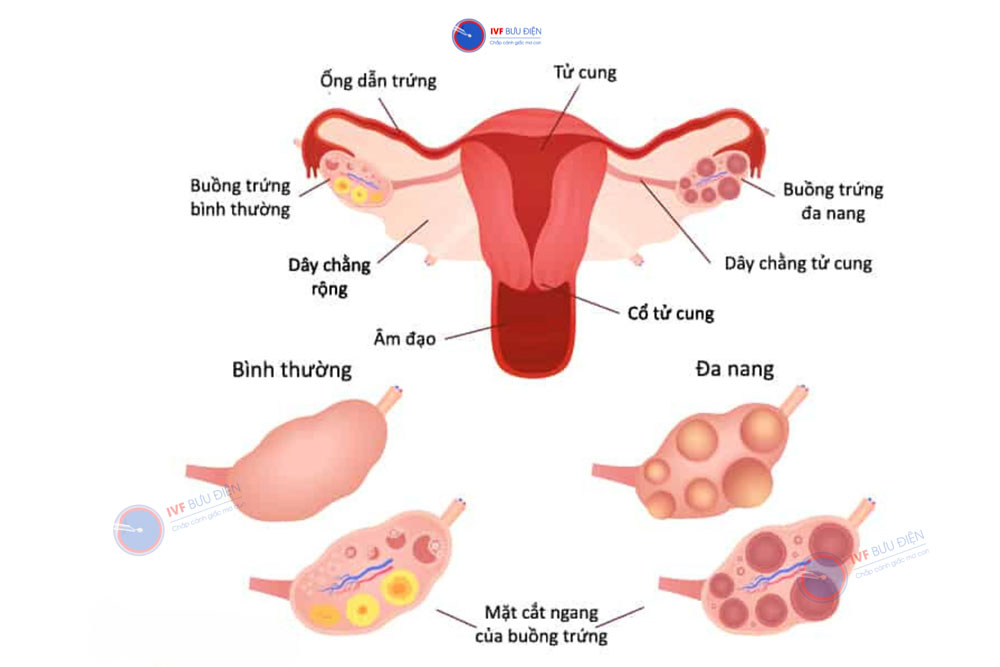 hội chứng buồng trứng đa nang