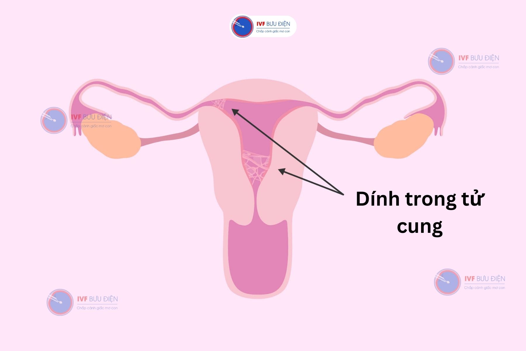 hình ảnh mô phỏng dính buồng tử cung