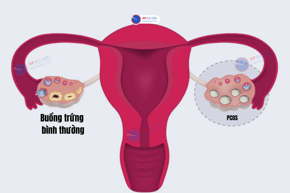 Hình ảnh đa nang buồng trứng