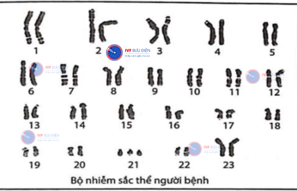 bất thường NST