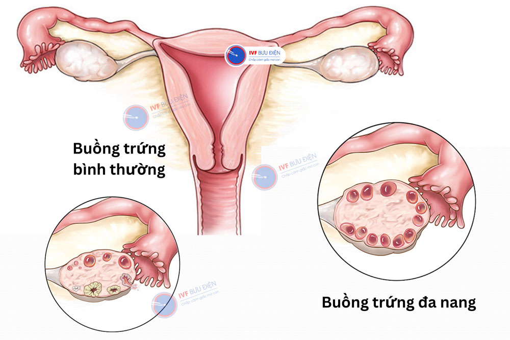 đa nang buồng trứng