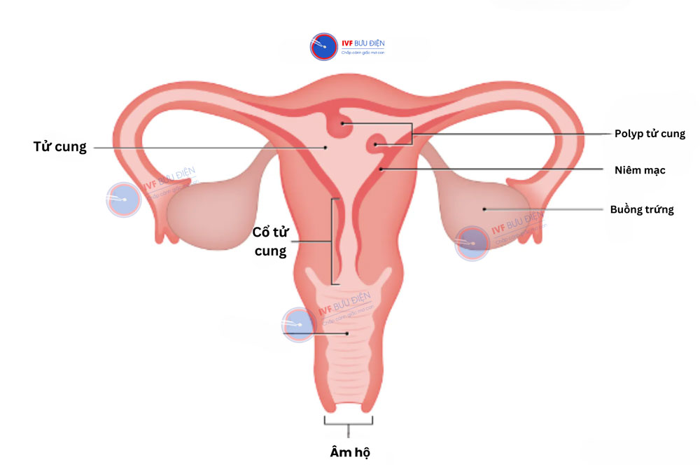 Polyp tử cung