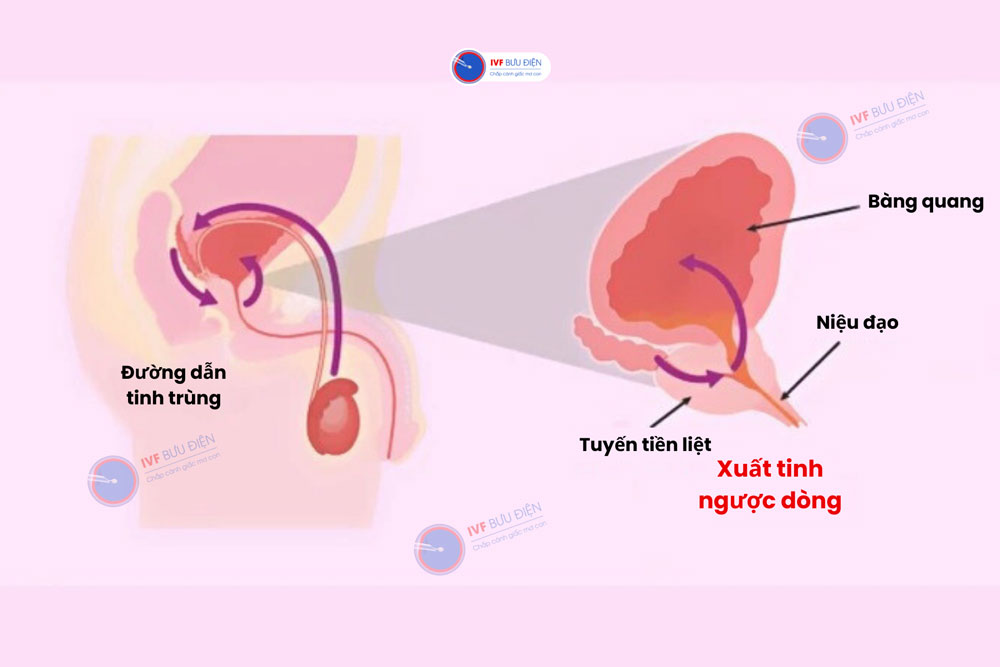 xuất tinh ngược dòng