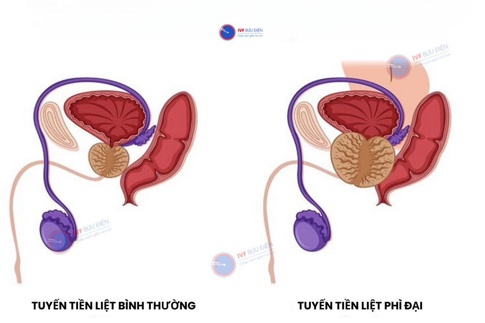 Tuyến tiền liệt phì đại gây áp lực lên niệu đạo khiến nam giới xuất tinh ngược dòng