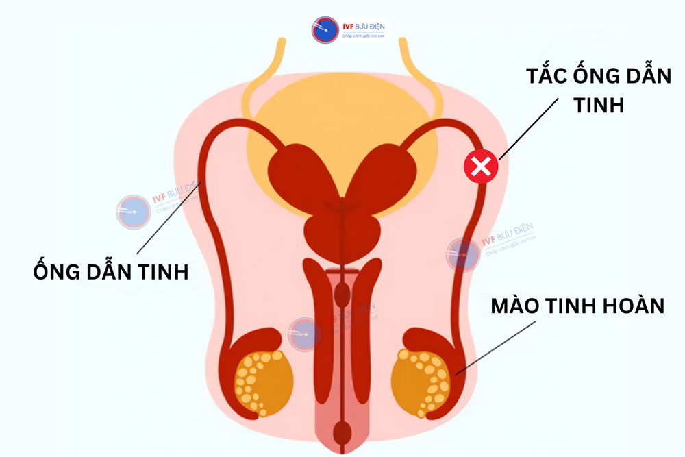 tắc ống dẫn tinh