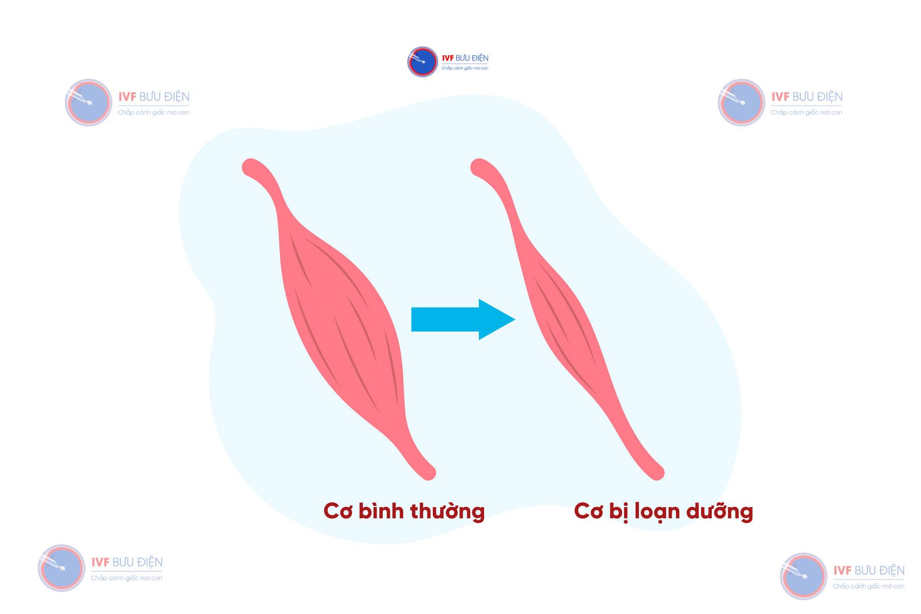 Loạn dưỡng cơ là tình trạng cơ bị teo, ảnh hưởng đến khả năng vận động
