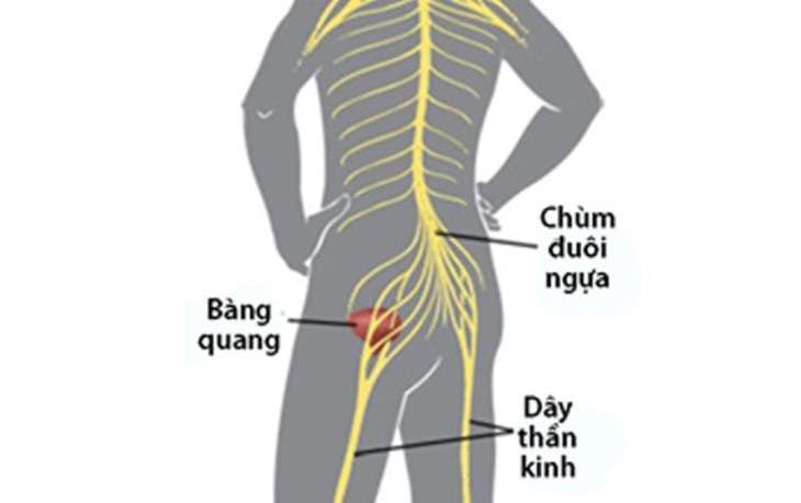 Tổn thương dây thần kinh khu vực đáy chậu, nhiễm trùng đường tiết niệu, từng phẫu thuật tuyến tiền liệt