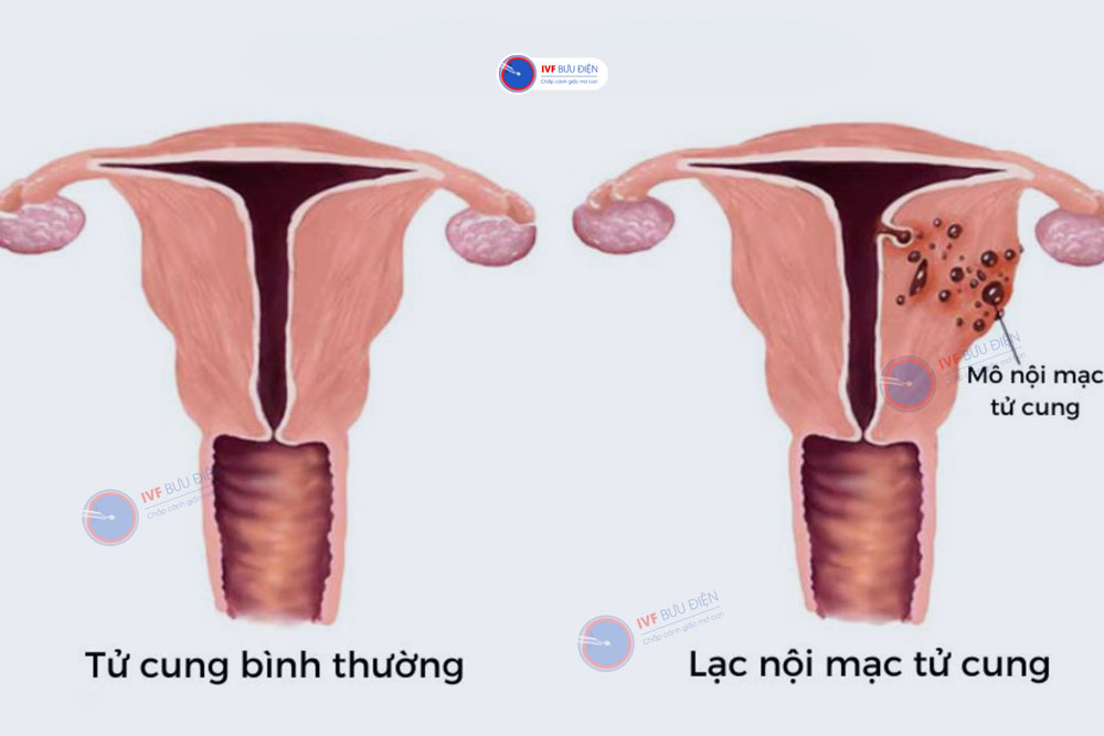 Lạc nội mạc tử cung