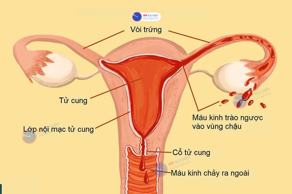 kinh nguyệt chảy ngược