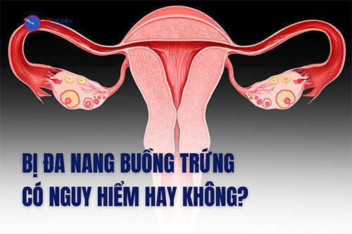 Bị buồng trứng  đa nang nguy hiểm không? Cần lưu ý gì?