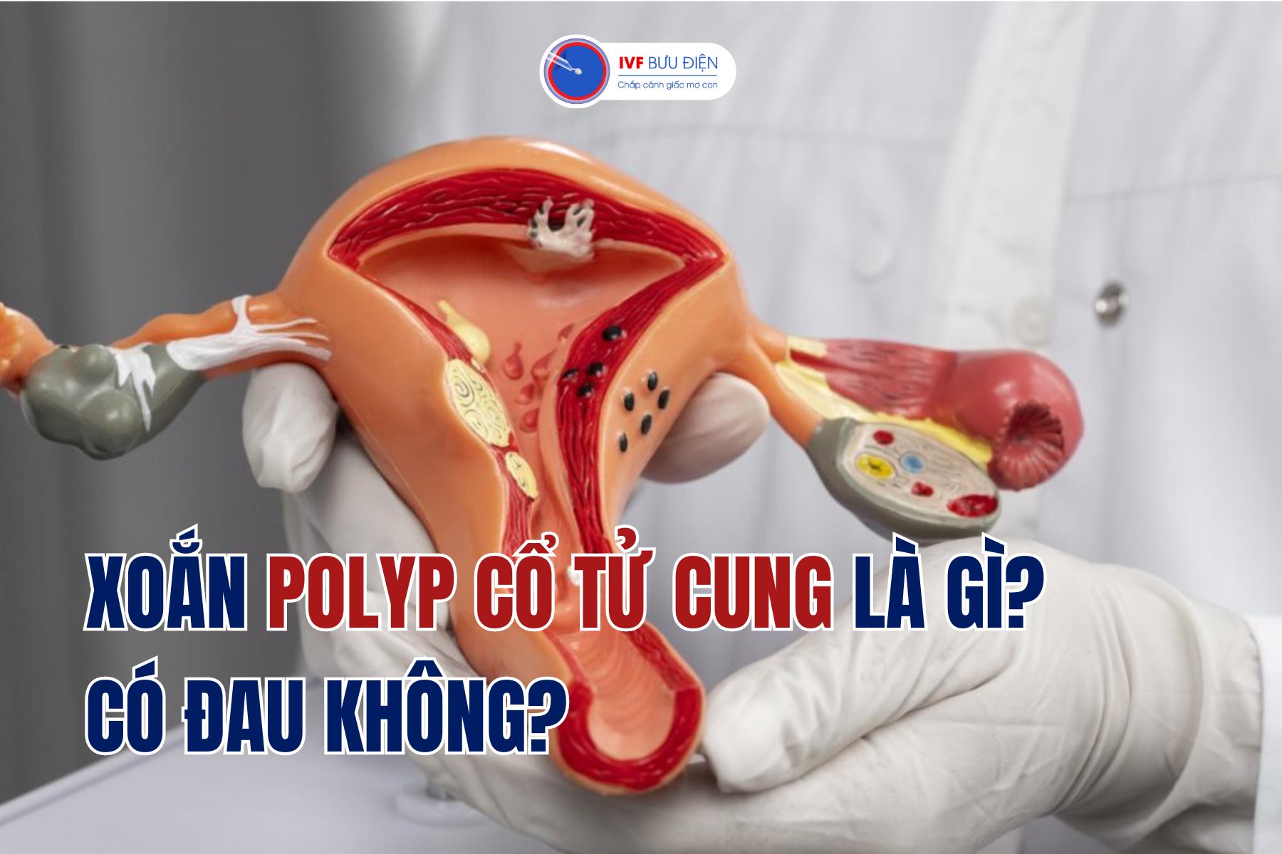 Xoắn polyp cổ tử cung là gì? Có đau không ? | IVF Bưu Điện