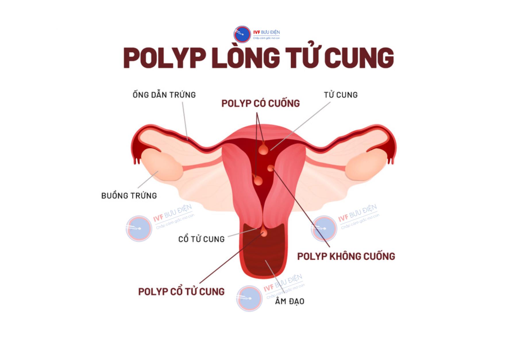 Hình ảnh polyp trong cổ tử cung