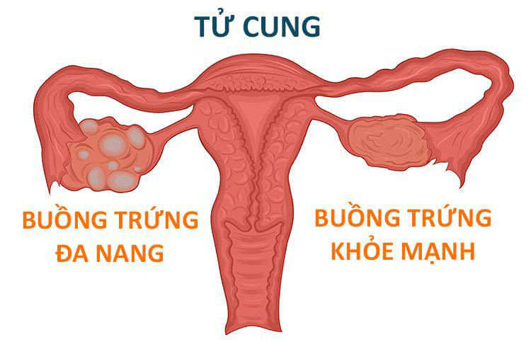 Bệnh đa nang buồng trứng và những nguy cơ tiềm ẩn