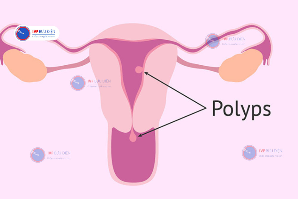 cắt polyp tử cung