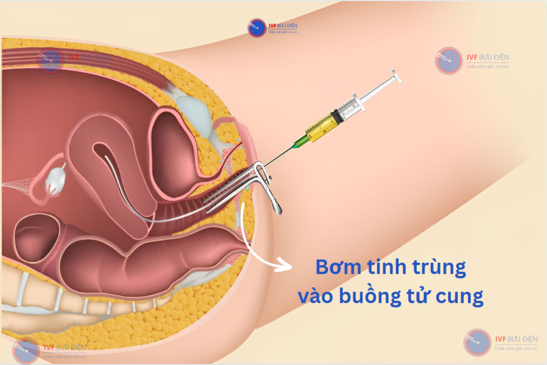 Kỹ thuật bơm tinh trùng vào buồng tử cung là phương pháp hỗ trợ sinh sản ít xâm lấn, an toàn