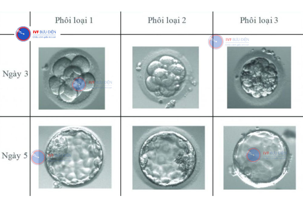 Chuyển phôi vào ngày thứ bao nhiêu của chu kỳ dựa vào tình trạng người phụ nữ