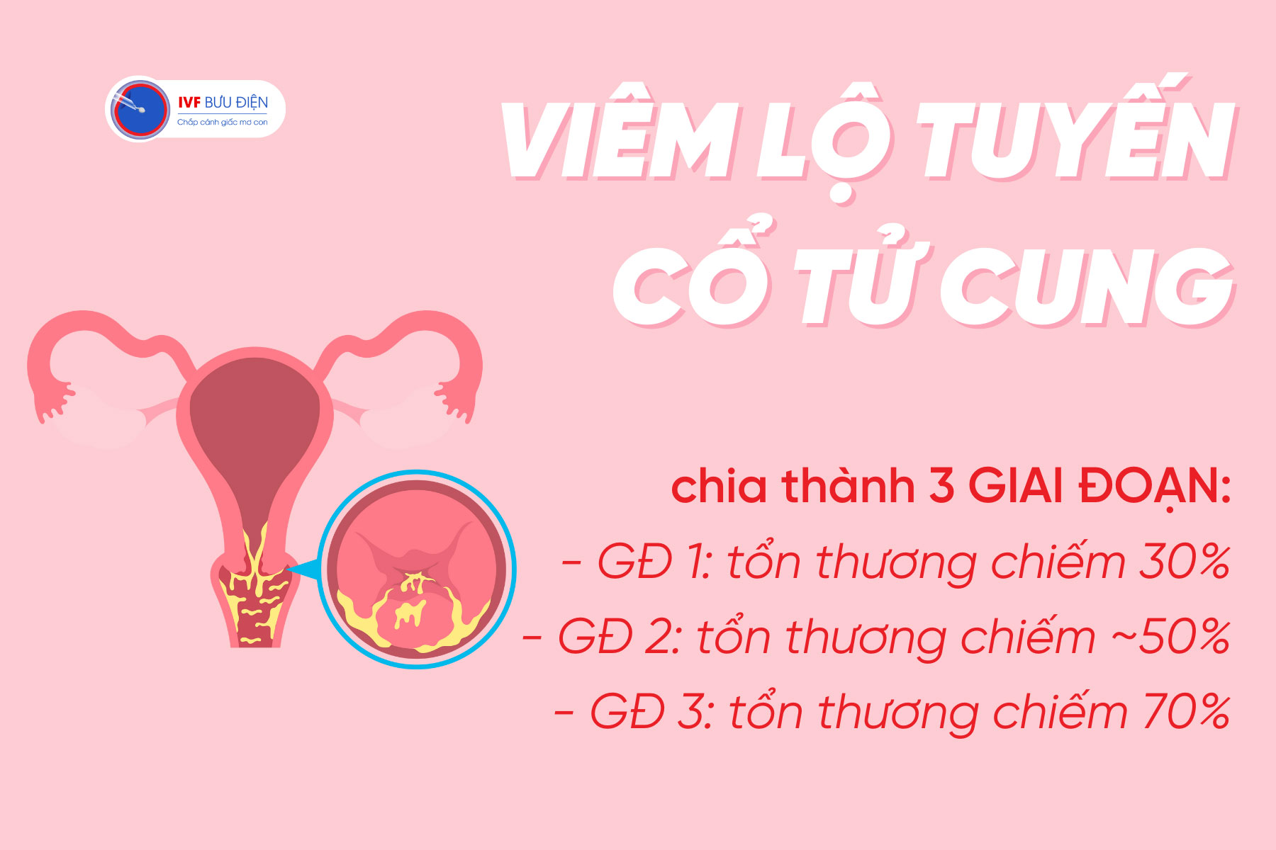 Viêm lộ tuyến cổ tử cung được chia thành 3 giai đoạn, trong đó giai đoạn cuối cùng là nguy hiểm nhất.
