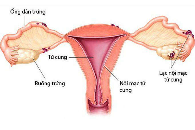 Lạc nội mạc tử cung và những điều cần biết