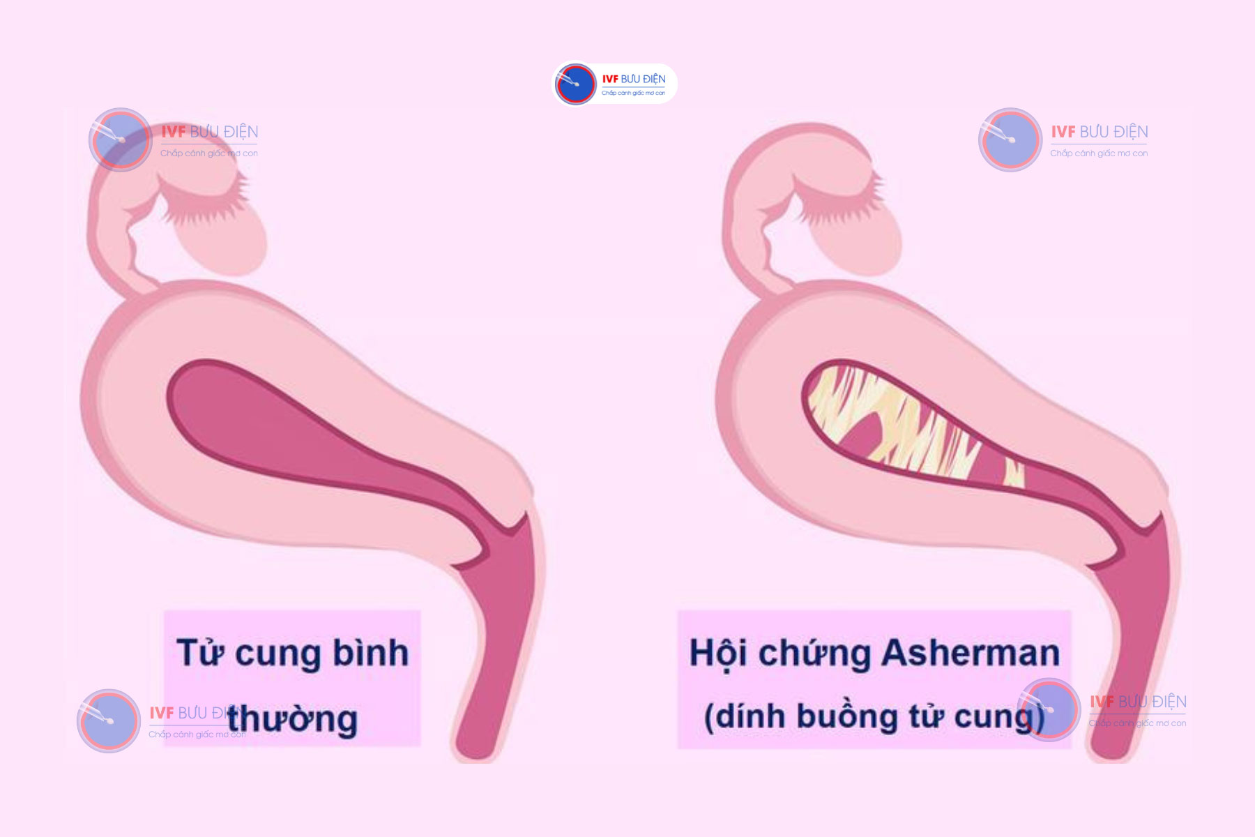 7. Lưu ý khi thực hiện mổ nội soi dính buồng tử cung