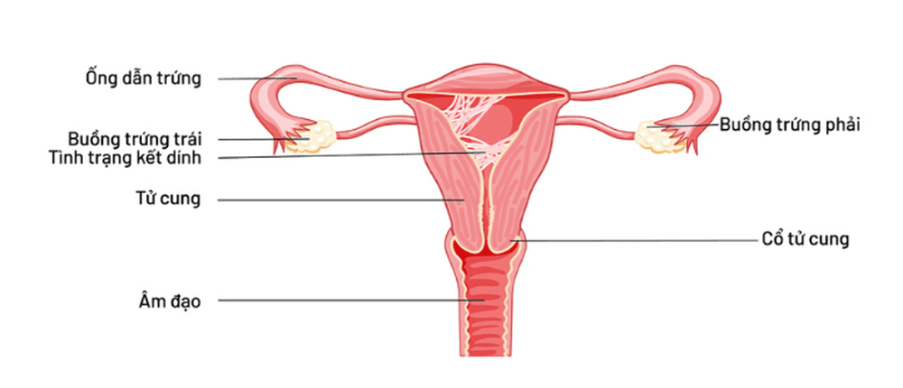 Dính buồng tử cung: triệu chứng, chẩn đoán và điều trị